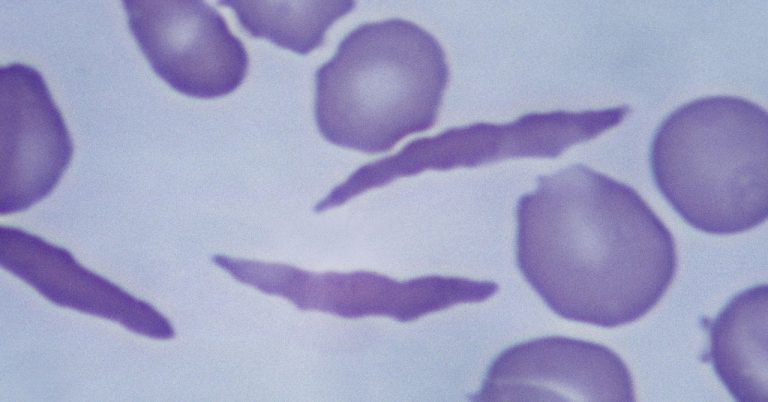 Sicklecell Science Gettyimages 139820362.jpg