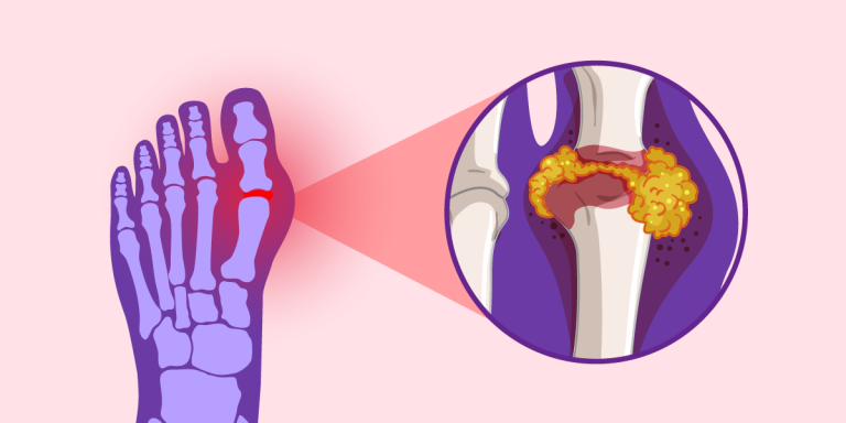 What You Need To Know About Gout.png