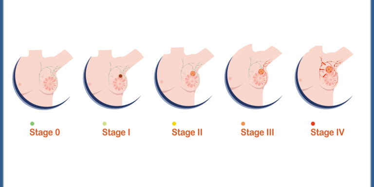 Medical Illustration Vector Concept Female Breasts And Four Levels Of Breast Cancer Severity.png