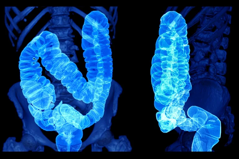 1800ss Getty Rf Ct Scan Of Colon.jpg