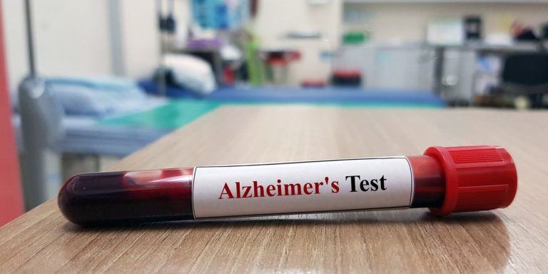 Laboratory Sample Of Blood Testing For Diagnosis Alzheimer S Disease.jpg